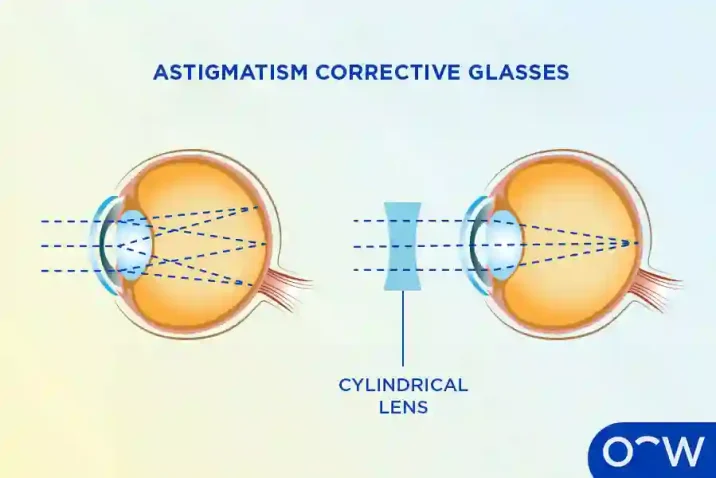 Correcting Astigmatism