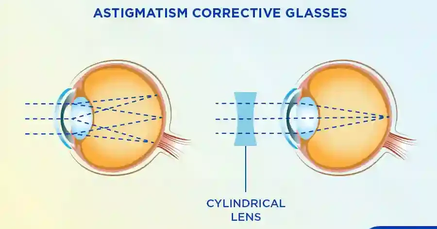 Correcting Astigmatism