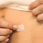 Estrogen Patch